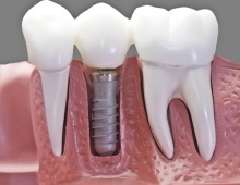 Implantaten Nijmegen